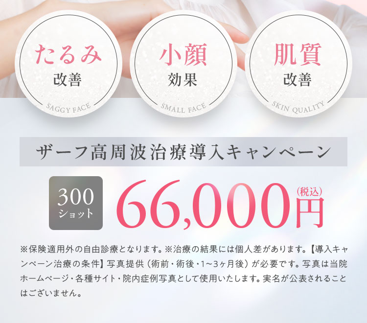 ザーフ高周波治療導入キャンペーン